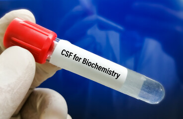 Biochemist hold Cerebrospinal fluid (CSF) sample for biochemistry test including glucose, protein,...