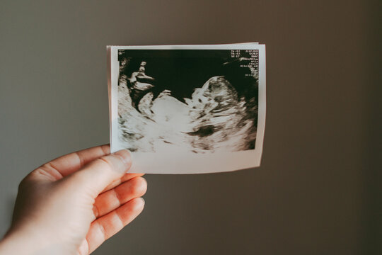 A snapshot of an obstetric ultrasound of the fetus in the hand. echography scan.