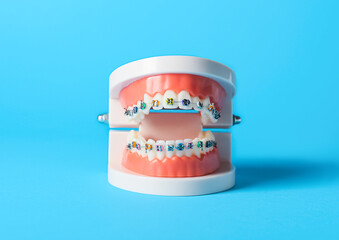 Model of jaw with braces on blue background