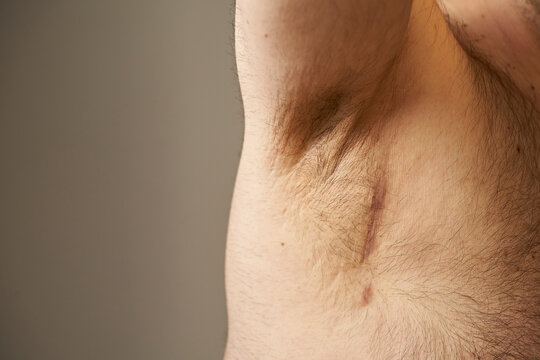 scar from a lymph node operation in the armpit area. lymphadenectomy