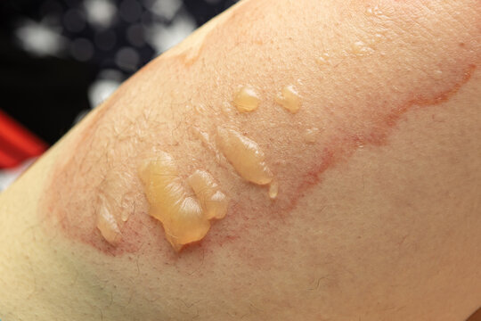 Close up leg with terrible burn. Injury after hot water on skin. Accident at home, scalds wound. Careless concept. Need emergency help.