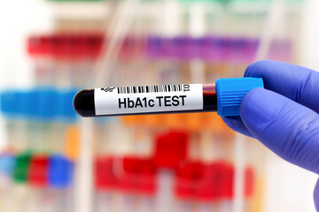 Blood sample for study of HbA1c or Hemoglobin A1c for detection of diabetes. doctor holding Blood tube for HbA1c analysis and identification of diabetic patient