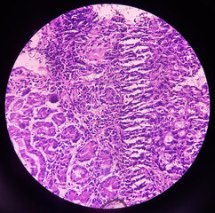 Cancer of the antrum, incisura of stomach, adenocarcinoma of stomach, show gastric mucosa, malignant neoplasm, microscopic 40x view.