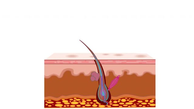 Hair removal laser epilation steps animation. Delete, remove, clean hair bulb depilation work stages. Permanent solution. Skin layers, anatomy, structure. Cosmetic, medical device, IPL. Video footage