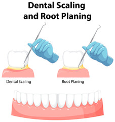 Infographic of human in dental scaling and root planing
