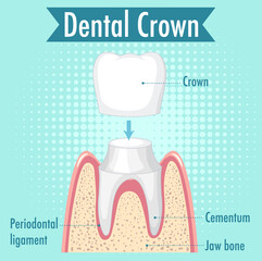 Infographic of human in dental crown
