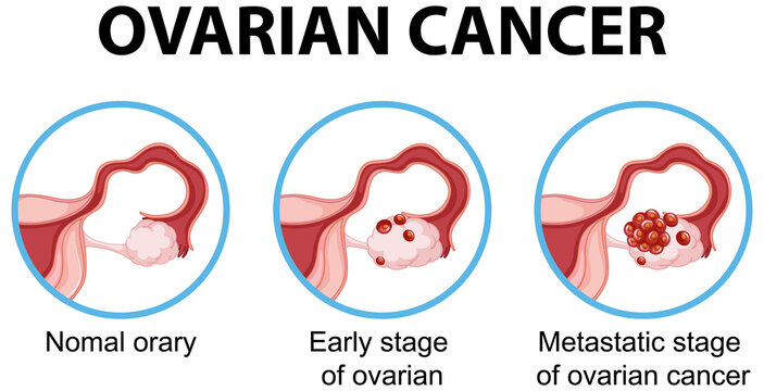 Ovarian cancer development process infographic
