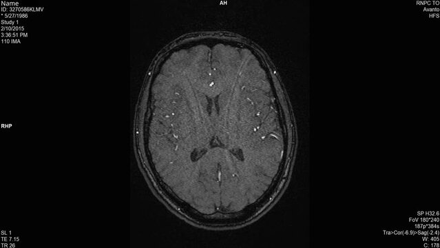 Magnetic resonance images of the brain (MRI brain), Time of flight angiography transverse plane sequencein cine mode. axial view of the TOF (ToF-3D) showing normal anatomy