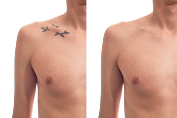 Before and after laser tattoo removal on a man.