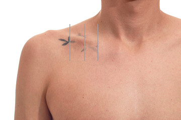 Laser tattoo removal procedure for men.
