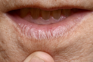 Obraz premium Chapped lips called cheilitis in Asian elder woman.