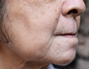 Enlarged pores in face of Asian, elder woman with skin folds.