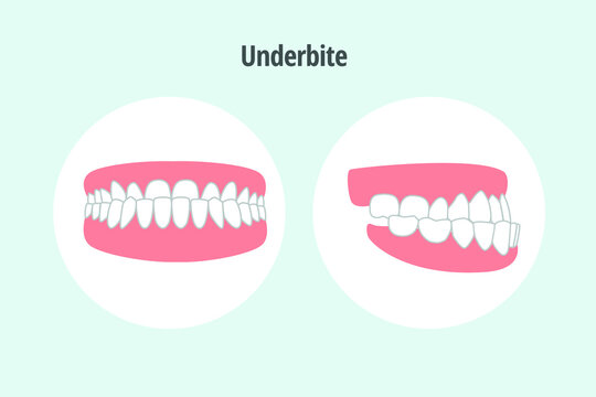 icon dental problem. vectorial illustration Underbite