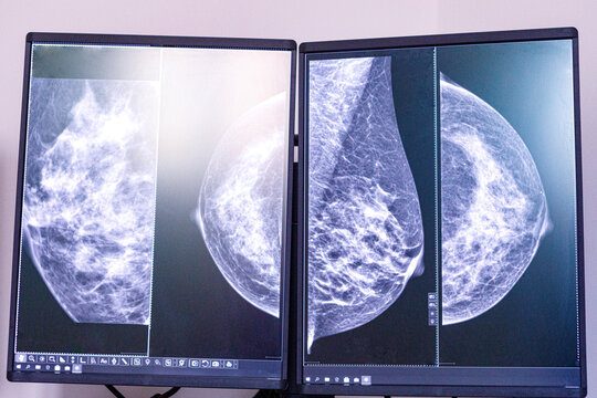 ecografia di un seno vista nel monitor di un computer