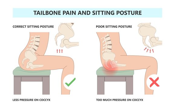 Tail bone pain floor hip spine sitting down back leg fall slip broken poor chair lower trauma tumor symptom joint surgery coccalgia good work from home computer ergonomic seating sacroiliitis 