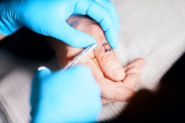 removal of sutures on the finger wound manually medical care