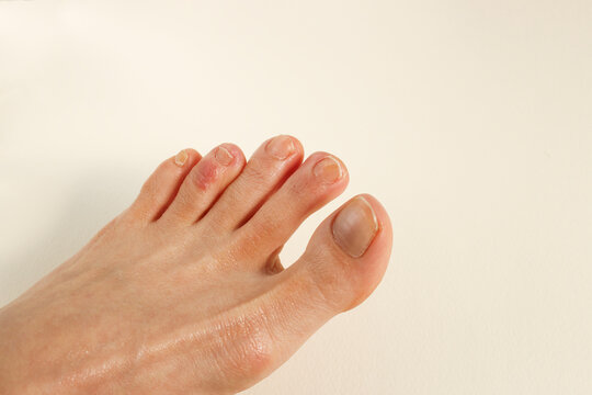 Middle-aged woman toes with chilblains