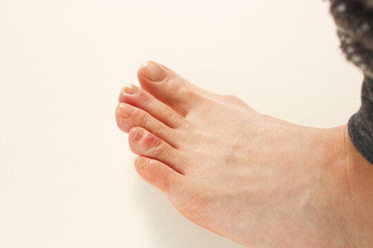 Chilblains on Toes of Middle-Aged Japanese Woman Close-Up