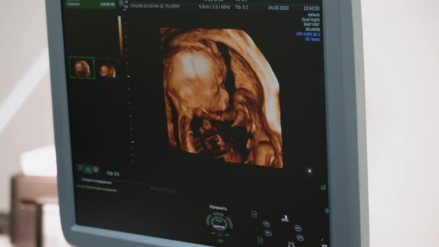 Ultrasonic screen. Image of the fetus in the womb. Observations during pregnancy. Examination of the unborn child. Ultrasound diagnosis. Modern survey methods. 3d image