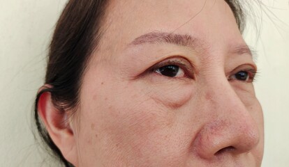 close up the flabbiness adipose hanging skin under the eyes, problem wrinkled skin on the face of the woman, concept health care.