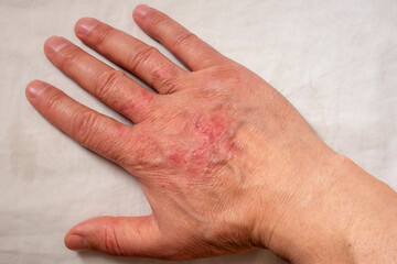 Fototapeta premium Healing burns on the arm. Scars on the arm after a thermal burn.