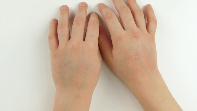 Kid hands close-up. Allergies, dermatitis on the skin. Children's health. Irritation on the skin. Baby Skin care