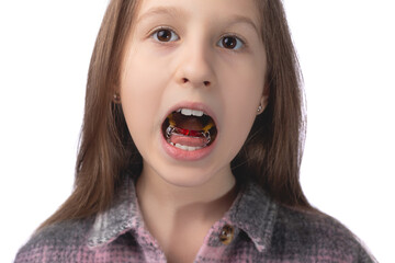A cute little girl shows an orthodontic appliance in her mouth. The concept of teeth alignment in childhood. Studio photo on a white background.