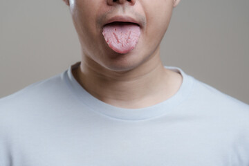 A man sticking out Fissured tongue, Bacterial infection disease tongue,The tongue is thrush.Tongue...