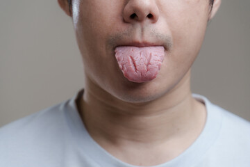 A man sticking out Fissured tongue, Bacterial infection disease tongue,The tongue is thrush.Tongue wound