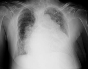 chest x-ray image of cardiomegaly 
