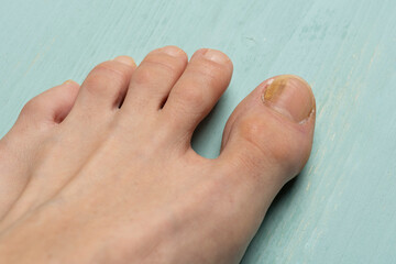 Toenails with fungus problems,Onychomycosis, also known as tinea unguium, is a fungal infection of...