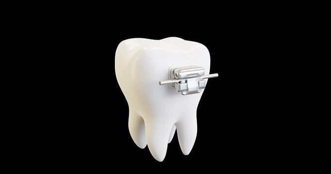 3d video installation of the arc in the lock, braces without ligatures. The iron arc moves and gets into the grooves of the bracket system installed on the white tooth, molar.