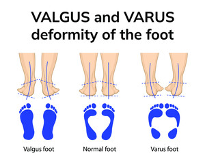 Illustration of the position of the feet in varus and valgus deformities. Depicted is a rear view of the feet and an imprint of the feet - obrazy, fototapety, plakaty