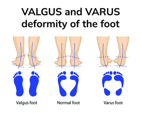 Underpronation, Supinated and High Arched Foot