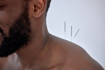 acupuncture therapy on back spine shoulders for black client. cropped young man undergoing...