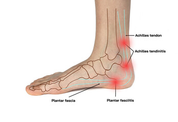 Close up foot with heel pain problem pain on rear foot  with red spots  point at pain in Achilles...