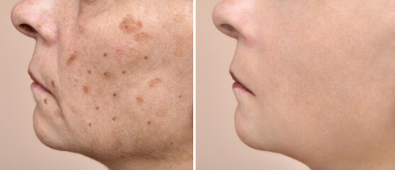 Woman before and after melasma and brown spots treatment on her face. Close-up. Skincare and health...