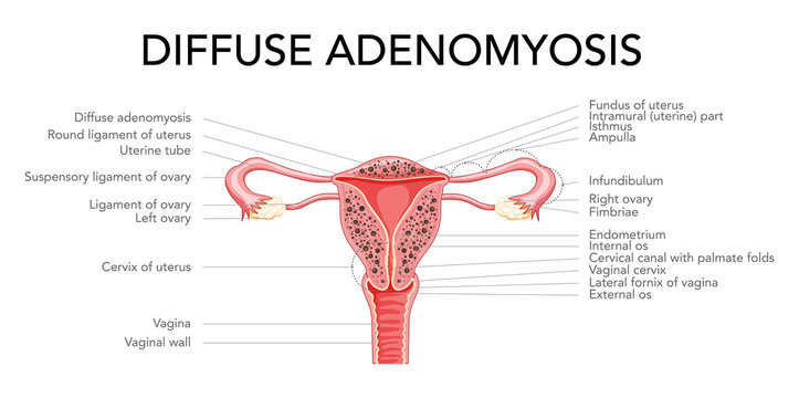 Diffuse Adenomyosis with inscriptions, Human anatomy Female reproductive Sick system organs. Structure of uterus, cervix, ovary, fallopian tube in Latin text. Frontal view in a cut Vector illustration