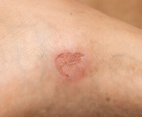 Fototapeta premium leg injury from uncomfortable shoes