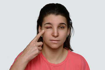 Portrait of woman with chalazion (hordeolum) on upper eyelid. Staphylococcus viral infection. The girl points her finger at the big eye.
