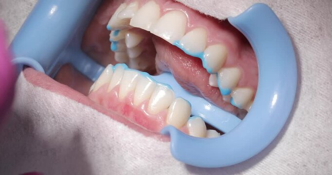 a dentist removes a blue paste from a patient's mouth with a probe and a blue lip lip expander during a teeth whitening procedure. close-up.