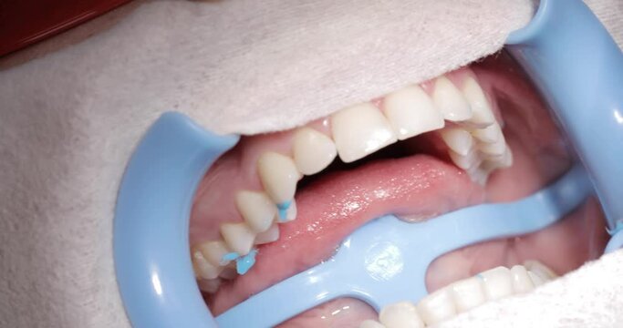 a dentist removes a blue paste from a patient's mouth with a probe and a blue lip lip expander during a teeth whitening procedure. macro