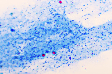 Cryptosporidium parvum protozoa positive (red sphere shape) in human stool smear, oocyst stage, acid-fast stain, analyze by microscope