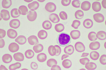 Target cells with abnormal red blood cells in blood smear, specimen from thalassemia patient,...