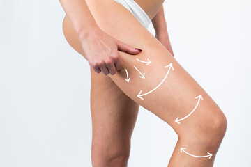 Cellulite removal scheme on body girl. White arrows markings on leg young girl.