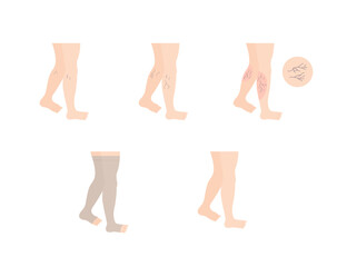 period of human leg with varicose veins and tight treatment vector