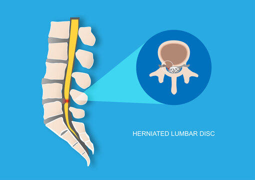 Vector illustration of back pain caused by herniated lumbar vertebral disc. Intervertebral disc protrusion causing nerve root compression.