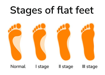 Illustration of three stages of flat feet. Four footprints depicted - normal position and stages of deformity  - obrazy, fototapety, plakaty