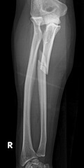 monteggia fracture, proximal ulna fracture with radial head dislocation, x ray 
