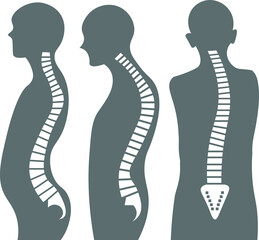 three types of spine deformities vector illustration art khyposis, lordosis, scoliosis